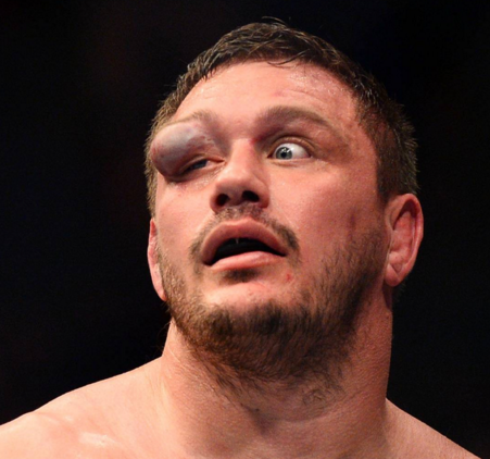 Mitrione UFC eye