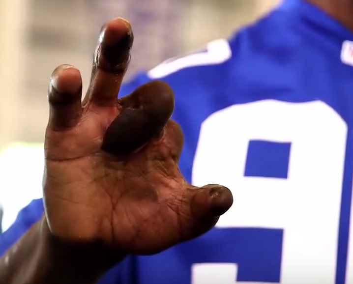 Jason Pierre Paul Shows Photos Of His Blown Off Hand To Promote 