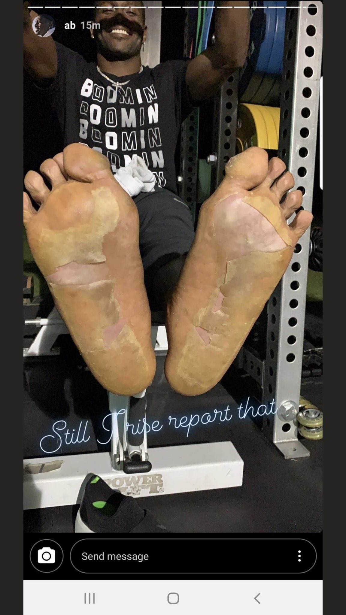 Antonio Brown Shows Off His Blistered Feet After Being Criticized For Bot Practicing ...