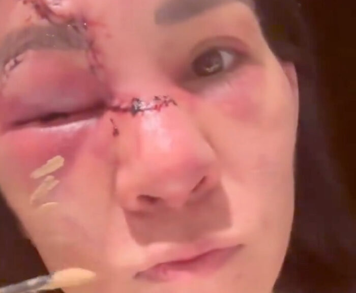 VIDEO: Fans Shocked At UFO Star Irene Aldana As She Applies Makeup To The Many Stitches On Her Face