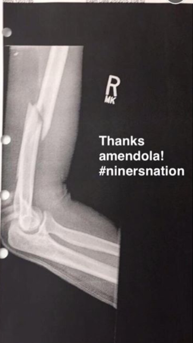 frat-amendola-breaks-girls-arm