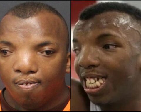 Split image of a Black man: left shows a neutral expression with missing front teeth in an orange shirt; right shows him smiling with several missing teeth and large gaps.