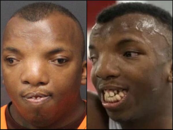 Split image of a Black man: left shows a neutral expression with missing front teeth in an orange shirt; right shows him smiling with several missing teeth and large gaps.